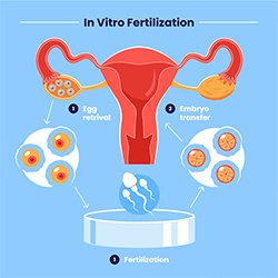 Diagnostic Hystero Laparoscopy for infertility | EVA IVF & Women's Centre