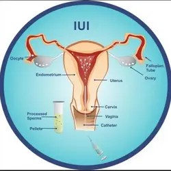 Laparoscopic Myomectomy | Treatment For Uterine Fibroids | EVA IVF & Women's Centre
