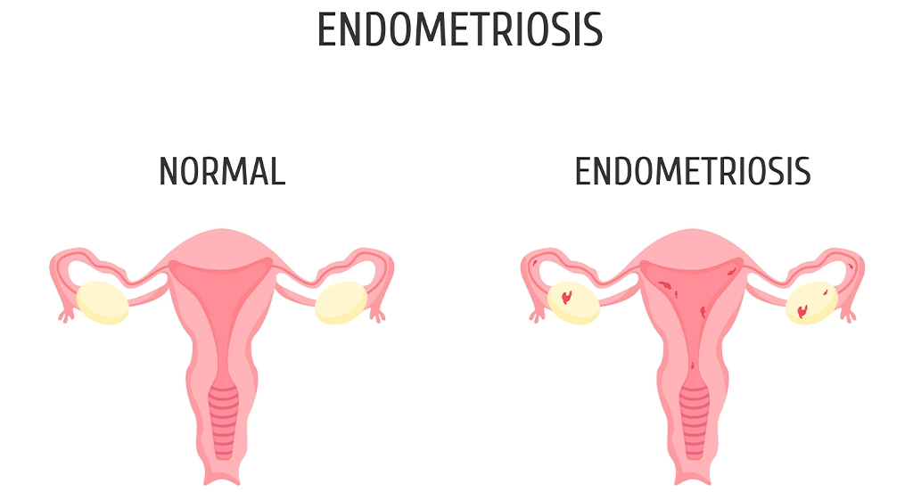 Low Cost IVF Treatment Package in Chennai | Best fertility center in Chennai | EVA IVF & Women's Care hospital