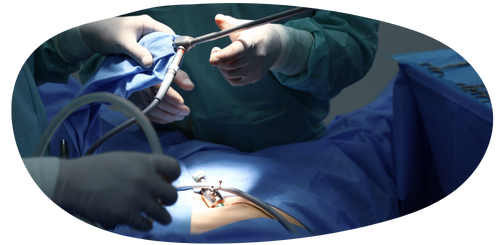 What is Laparoscopic PCOD Drilling