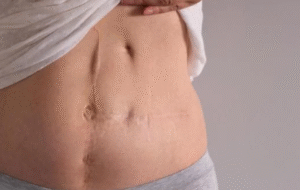 Possible Side Effects and Complications
