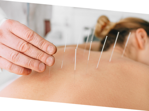 What Is Acupuncture