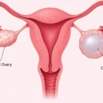 Medical illustration of the female reproductive system showing a normal ovary and an ovary with an ovarian cyst.
